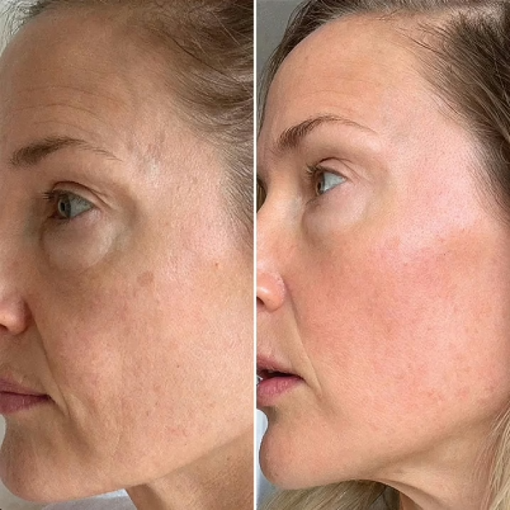 GloraMD Before and After - Result 1