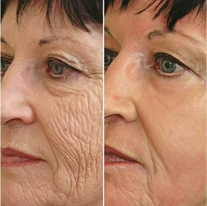 GloraMD Before and After - Result 2